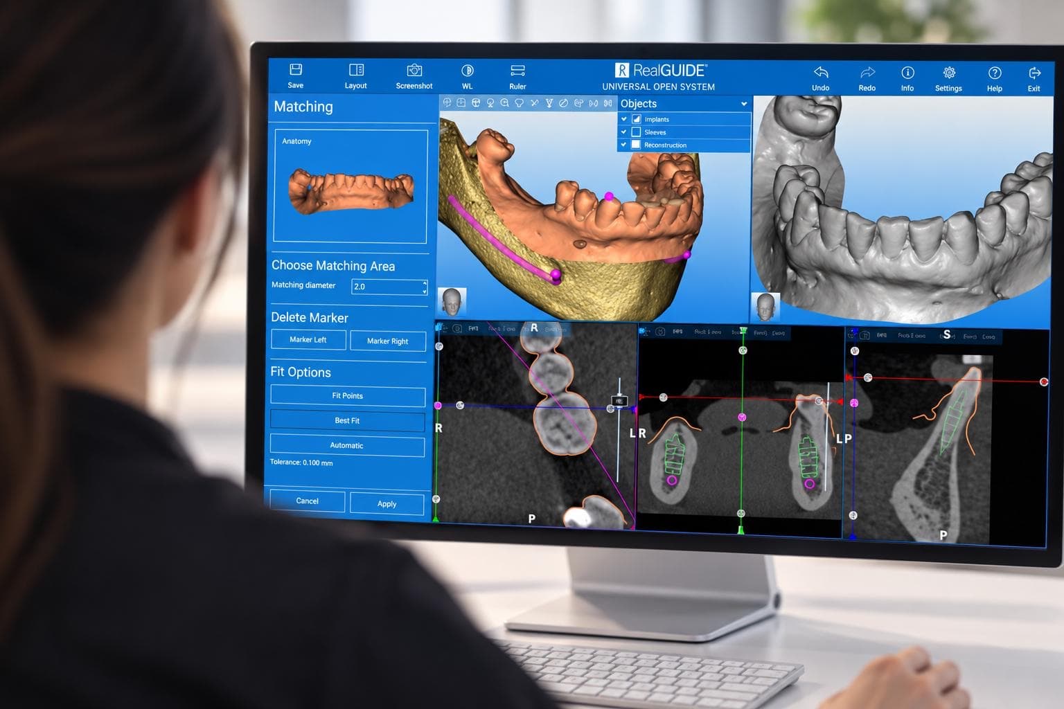 A three-dimensional implant plan being prepared in guided surgery software